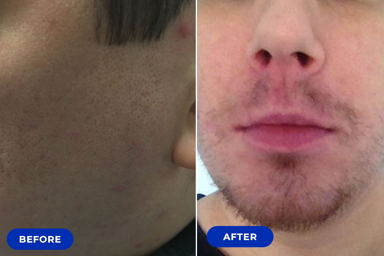 Before&after Beard Transplant2