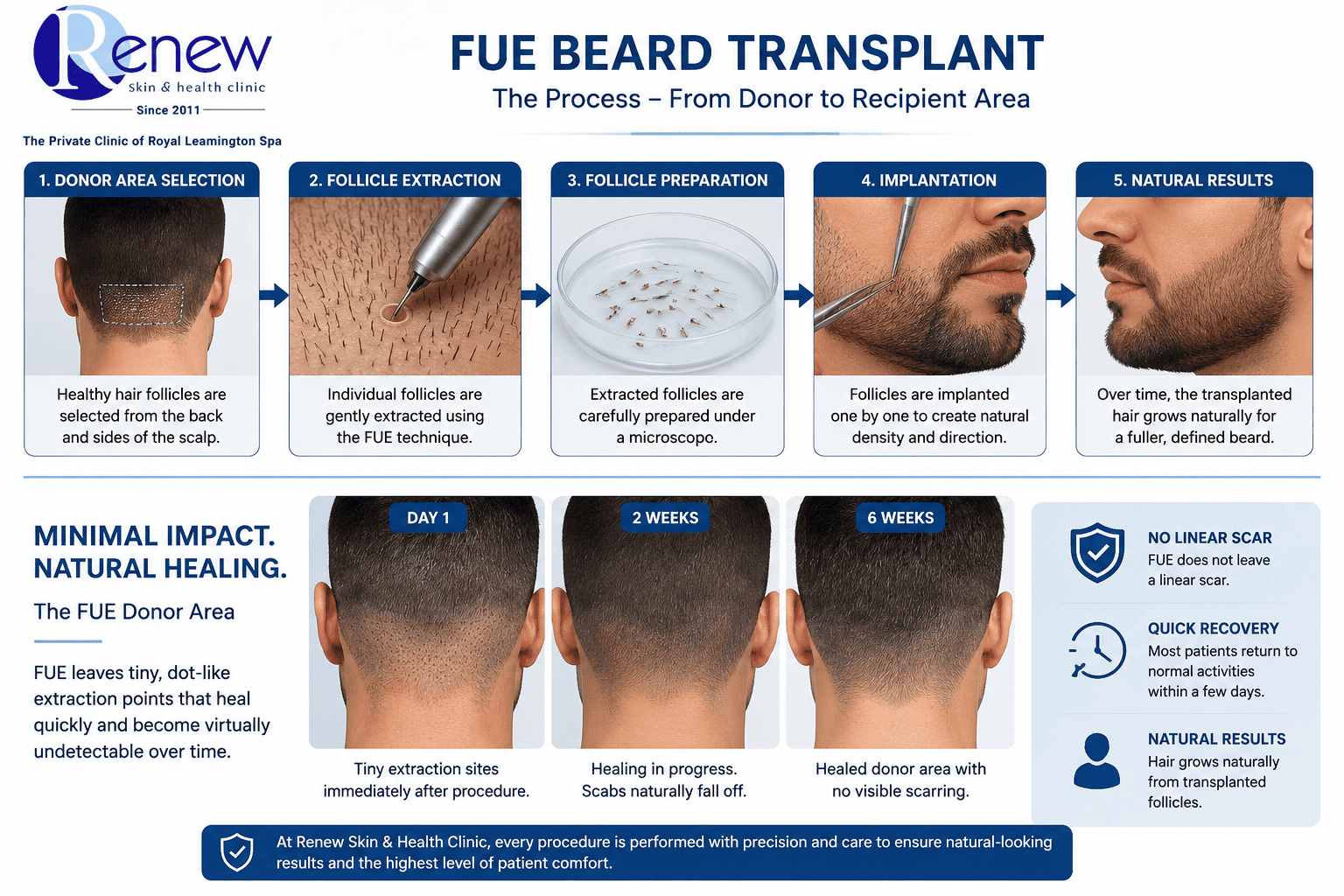 FUE beard transplant donor area healing Renew Clinic Leamington Spa FUE beard transplant donor area healing Renew Clinic Leamington Spa