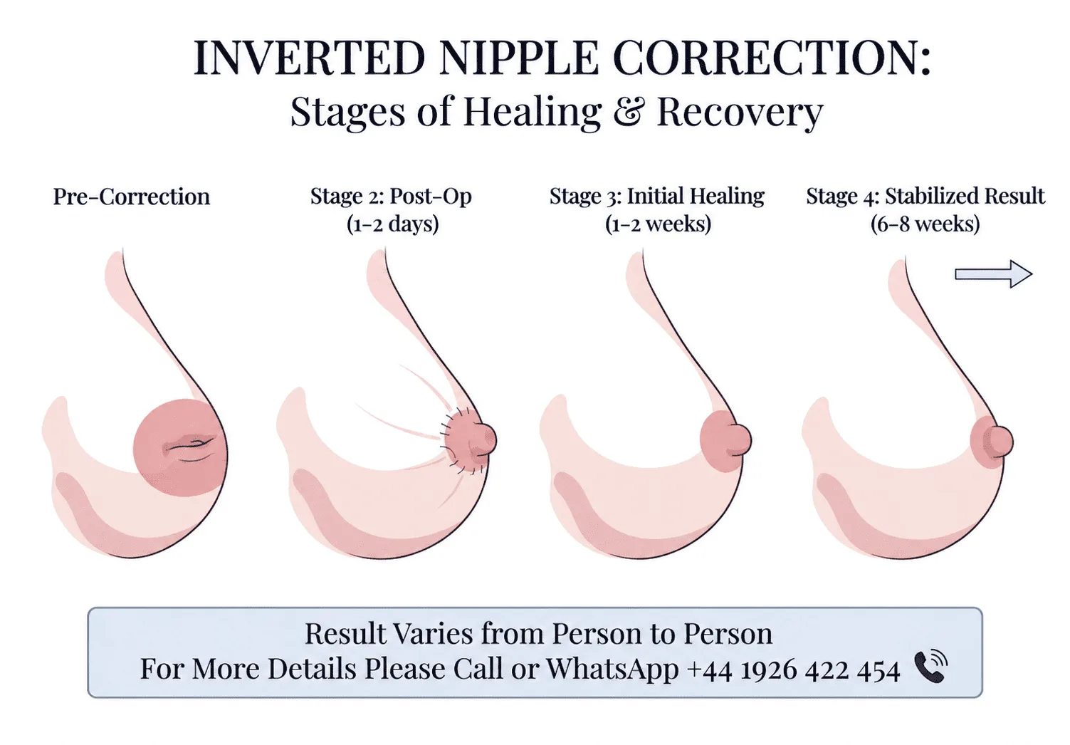 Recovery After Inverted Nipple Correction
