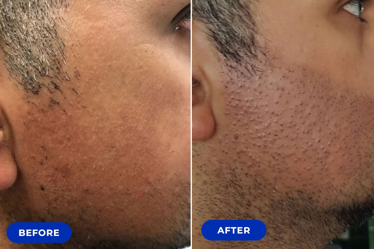 Before&after Beard Transplant
