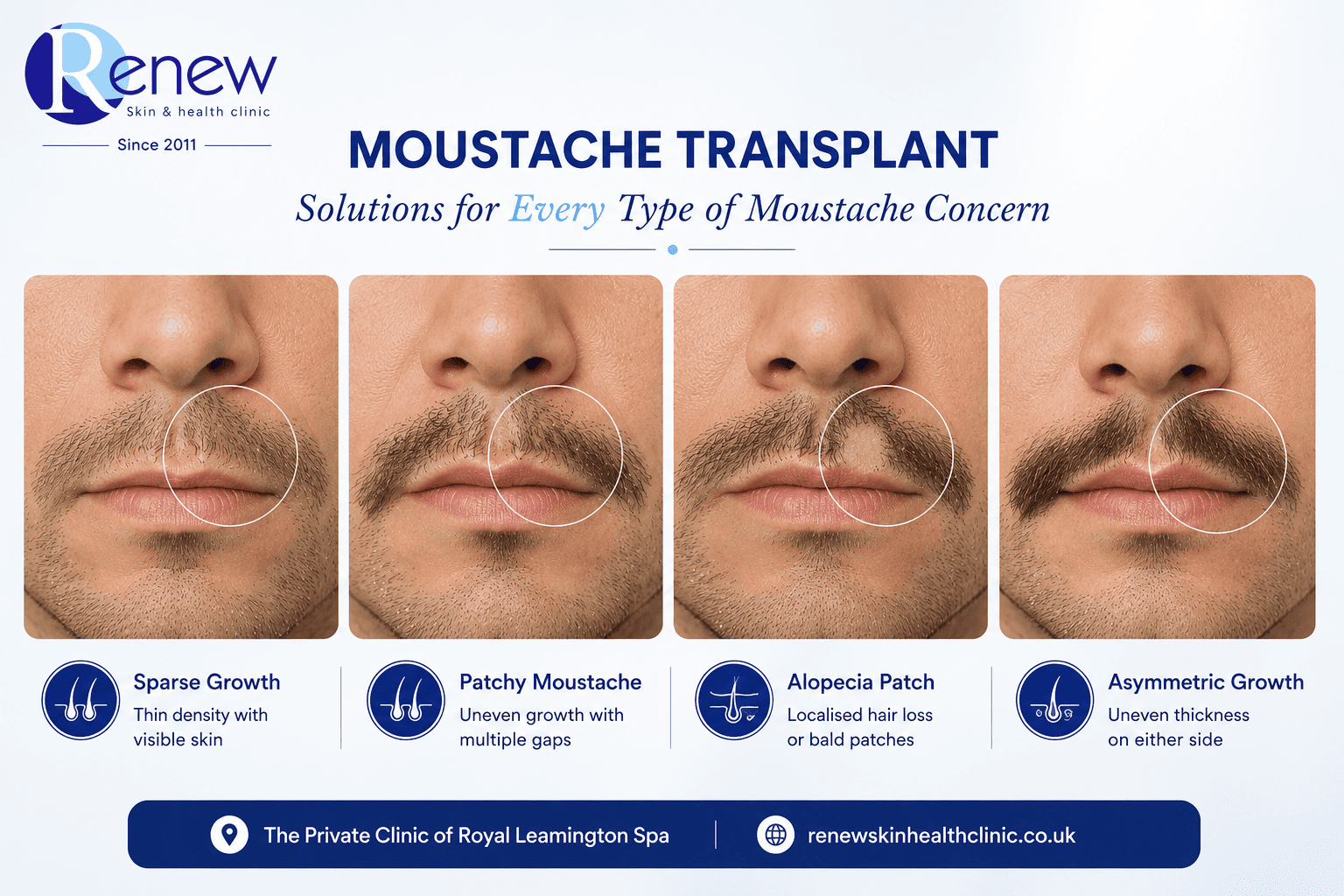 moustache transplant candidates sparse patchy alopecia Leamington Spa moustache transplant candidates sparse patchy alopecia Leamington Spa
