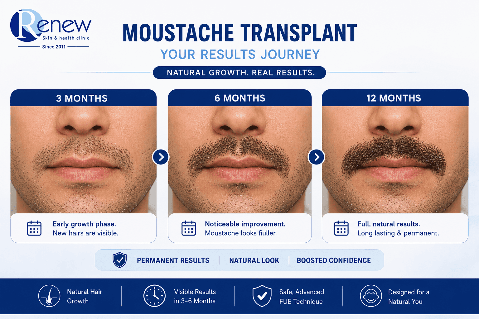 moustache transplant monthly results moustache transplant monthly results