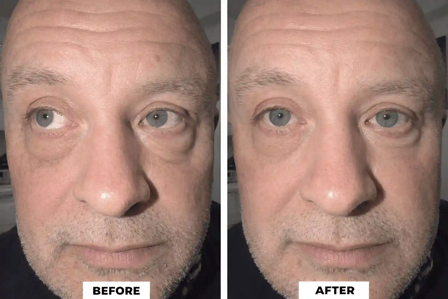 Xanthelasma treatment before and after results for patient 1