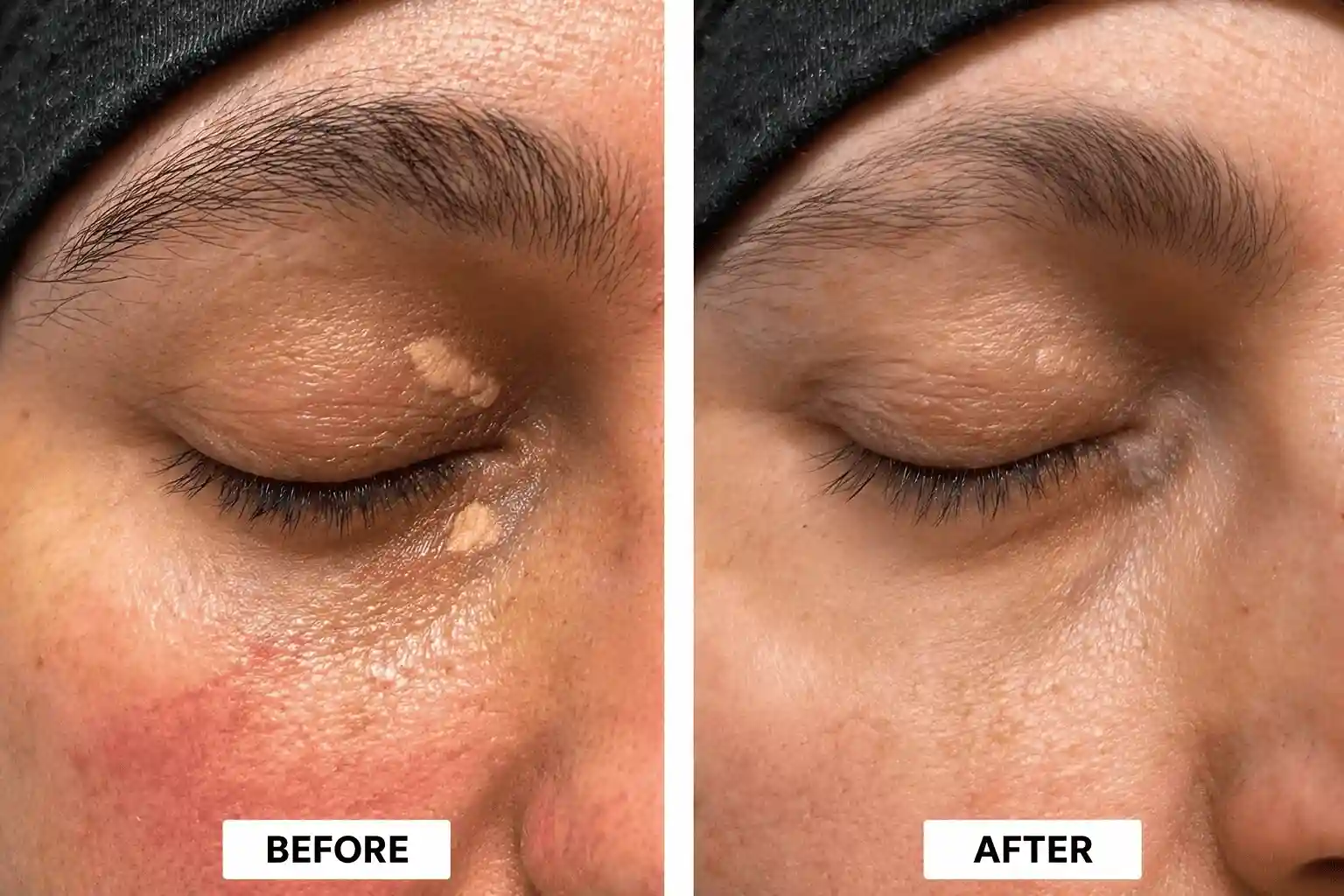 xanthelasma-treatment-before-after-patient-02