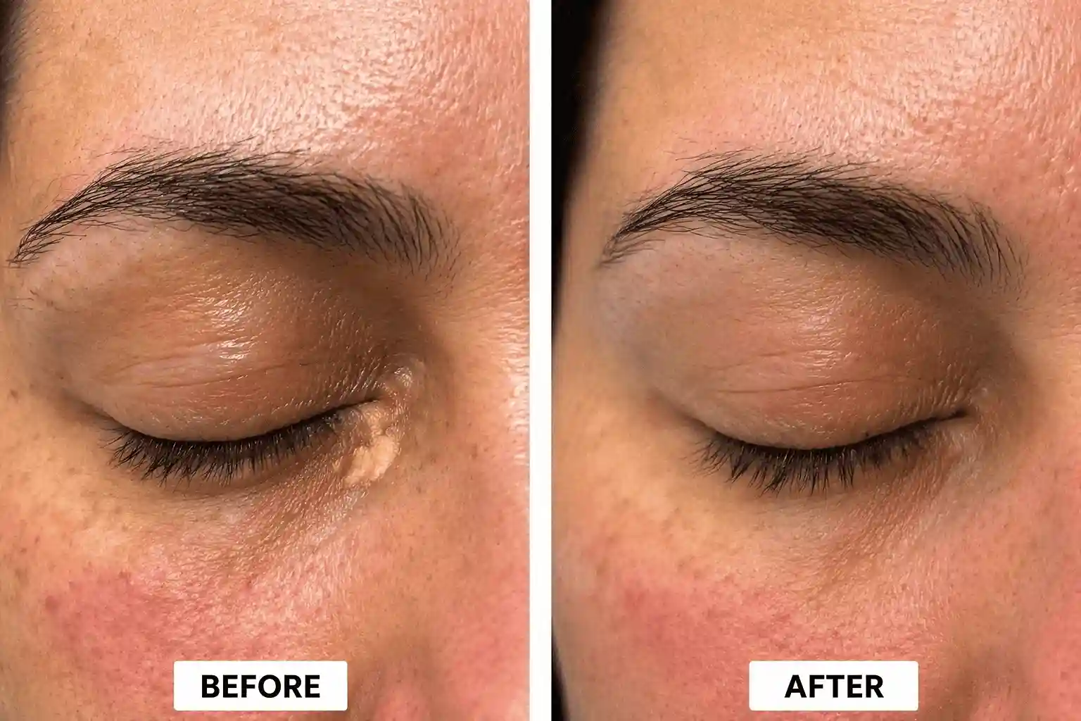 Xanthelasma treatment before and after results for patient 3