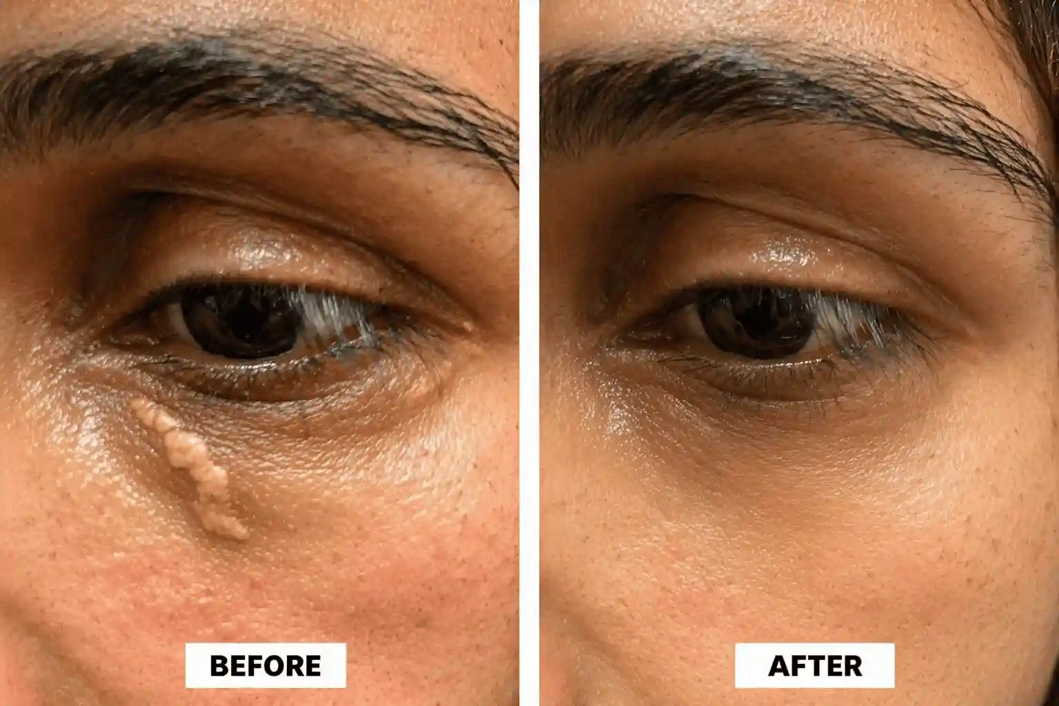 Xanthelasma treatment before and after results for patient 8