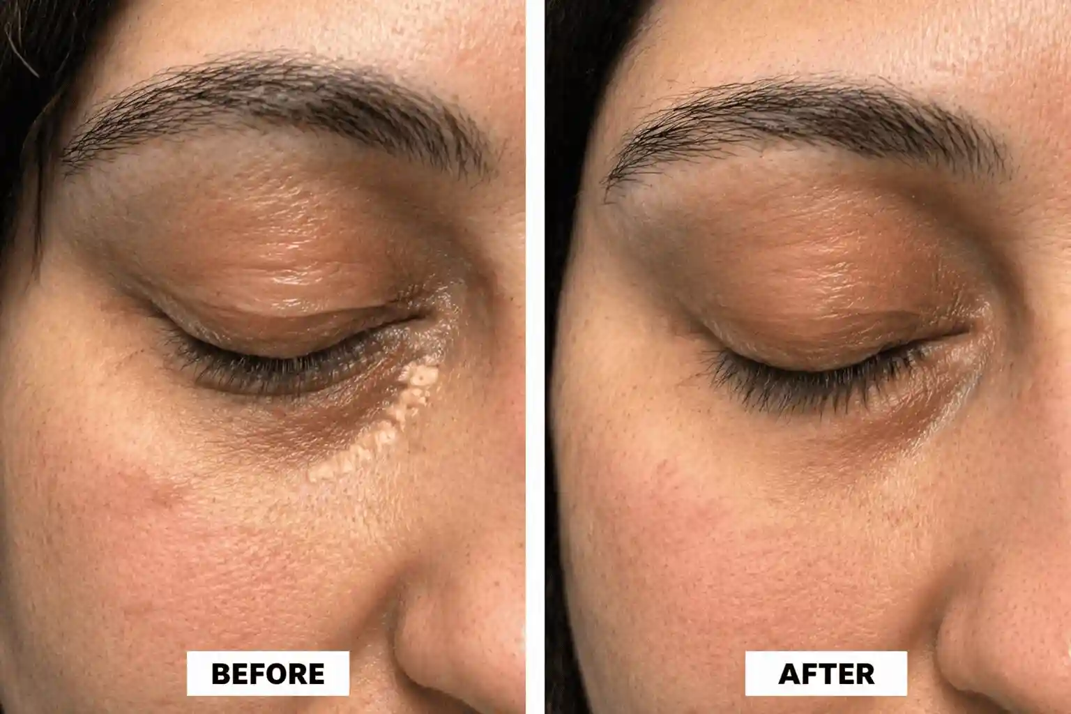 Xanthelasma treatment before and after results for patient 9