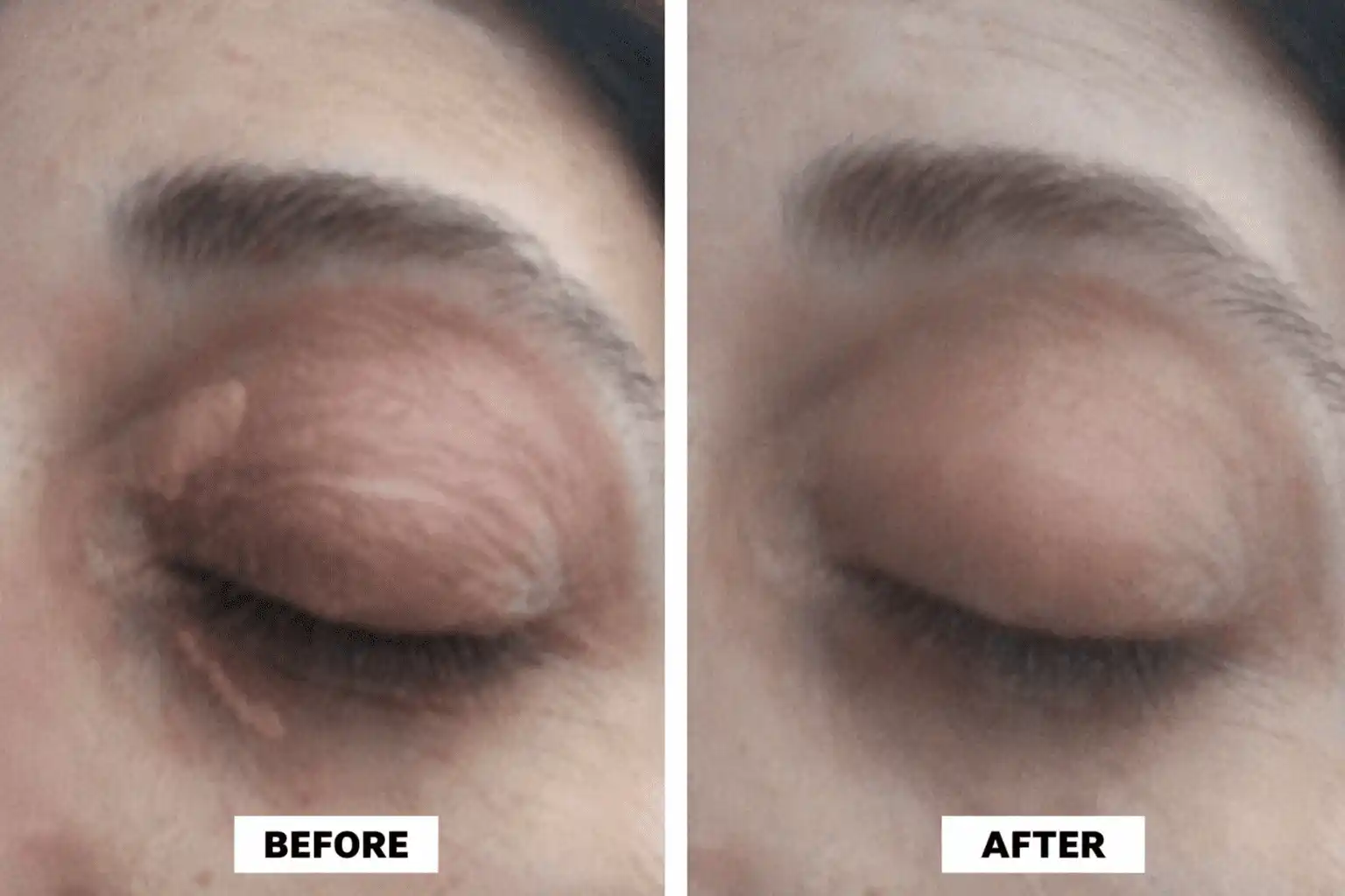 Xanthelasma treatment before and after results for patient 10