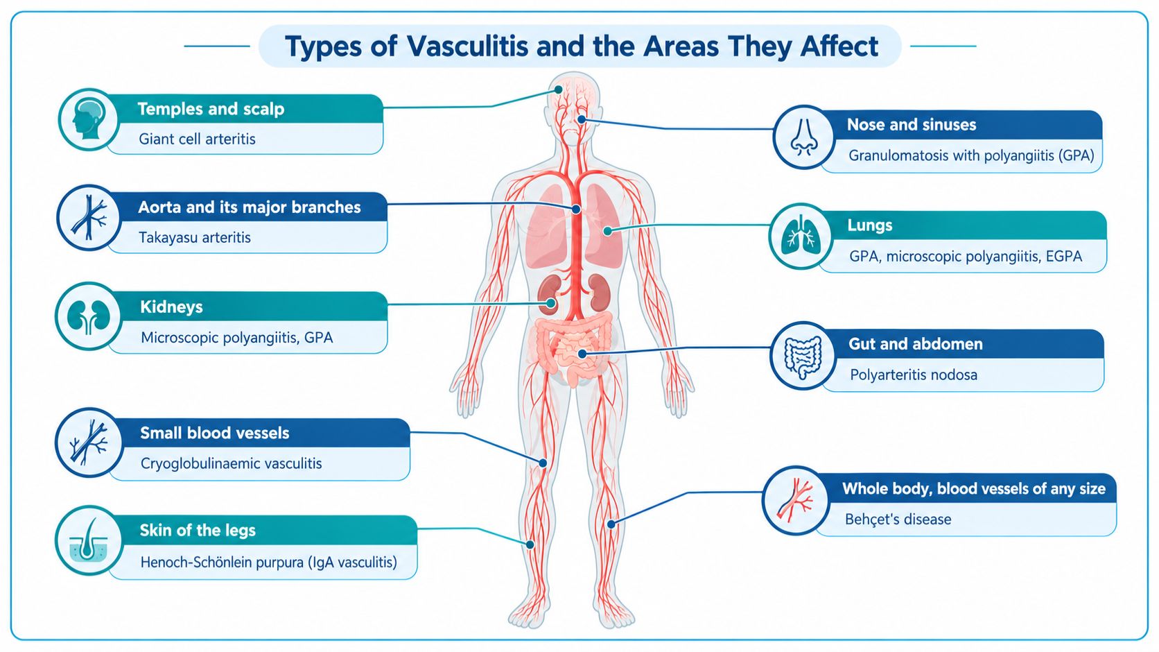 Body diagram showing the areas affected by different types of vasculitis, including the scalp, nose, lungs, kidneys and gut