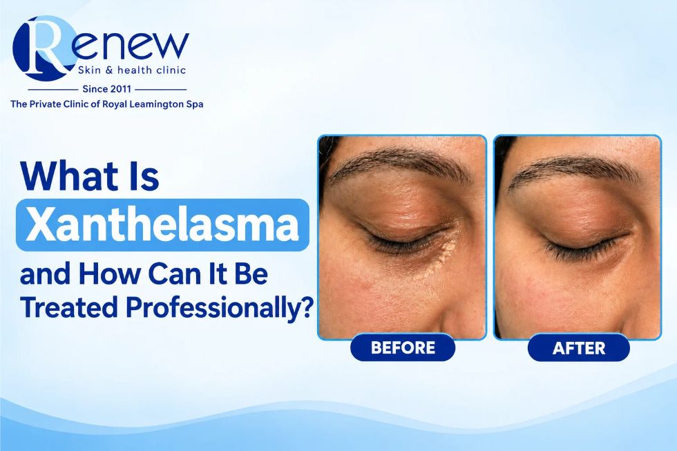 Renew Skin & Health Clinic – What Is Xanthelasma and How Can It Be Treated Professionally? Before and after images showing professional xanthelasma removal treatment.