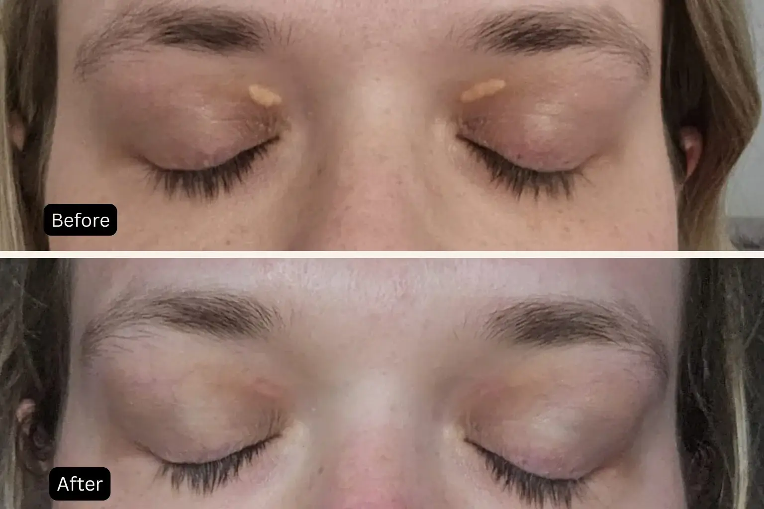 Xanthelasma treatment before and after results for patient 1