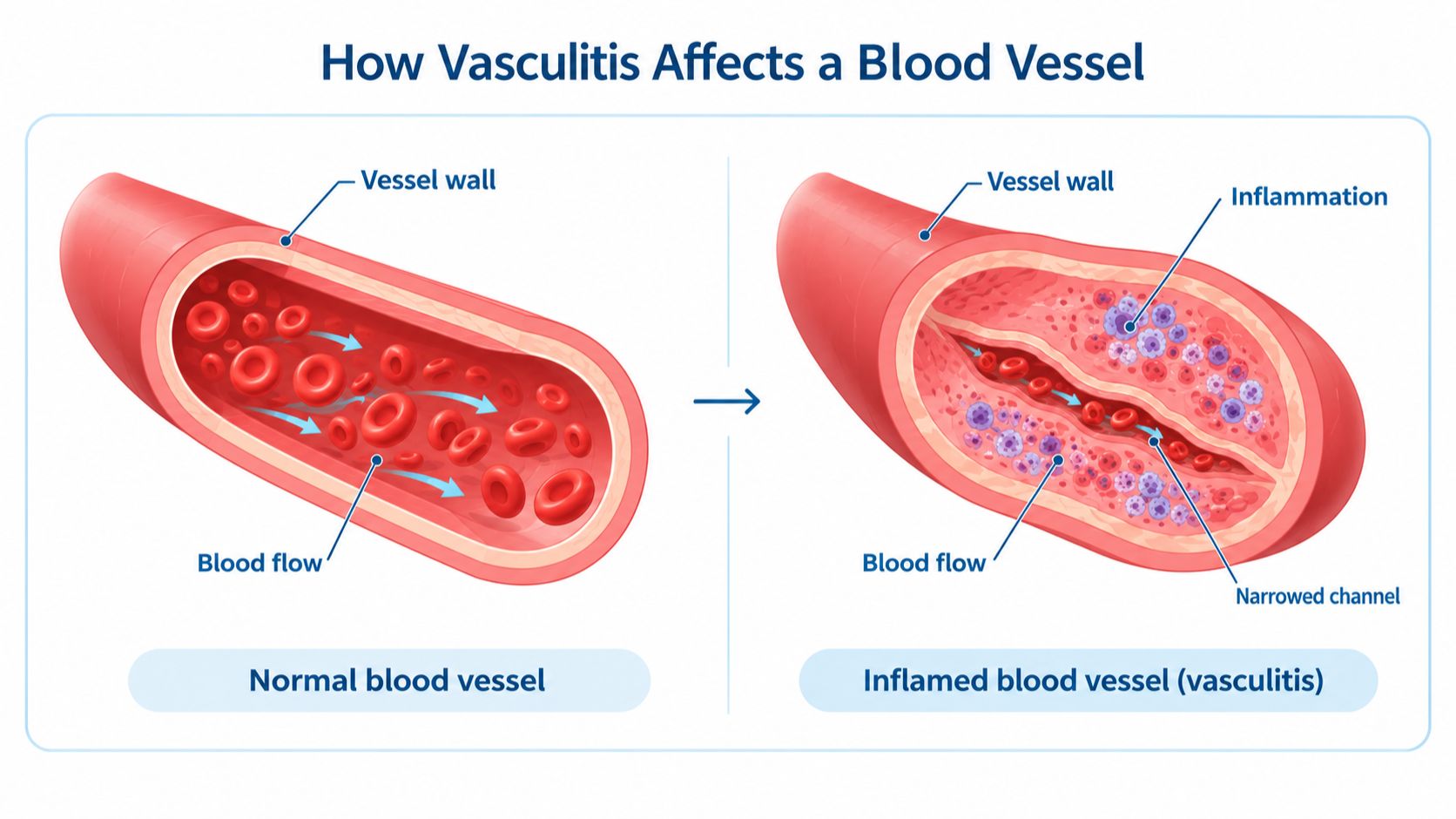 Diagram comparing a normal blood vessel with an inflamed, narrowed blood vessel in vasculitis